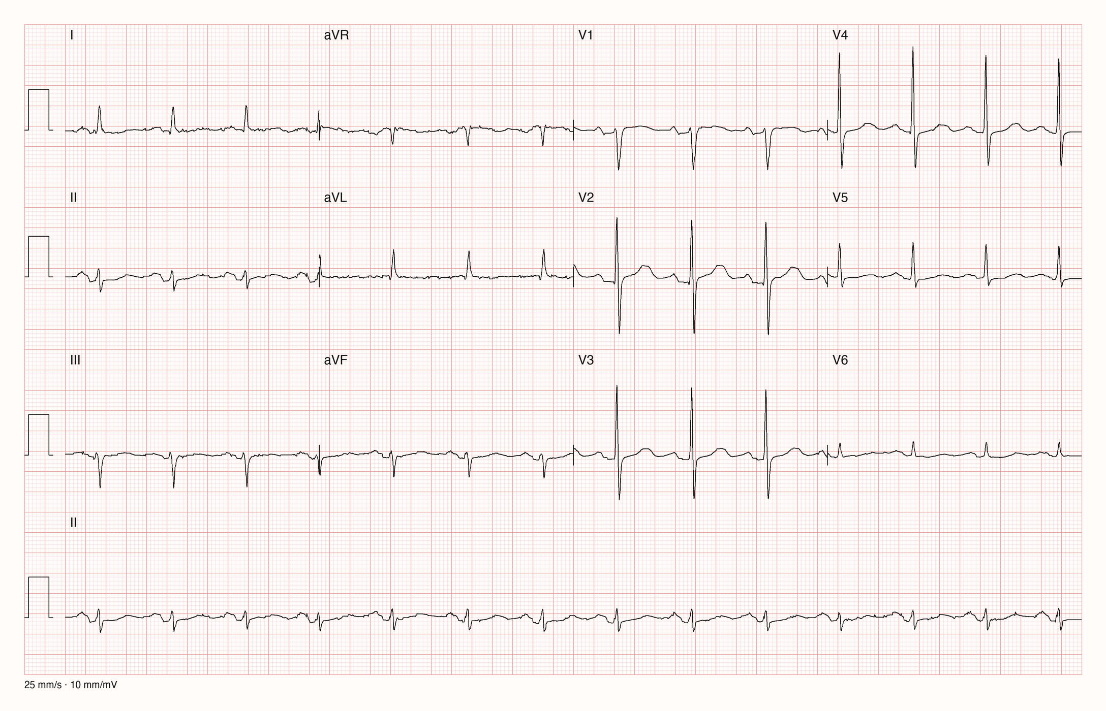 12-Kanal-EKG im Sinusrhythmus mit kleinen Ausschlägen in II und III, überwiegend negativem QRS in III und aVF und biphasischer P-Welle in V1