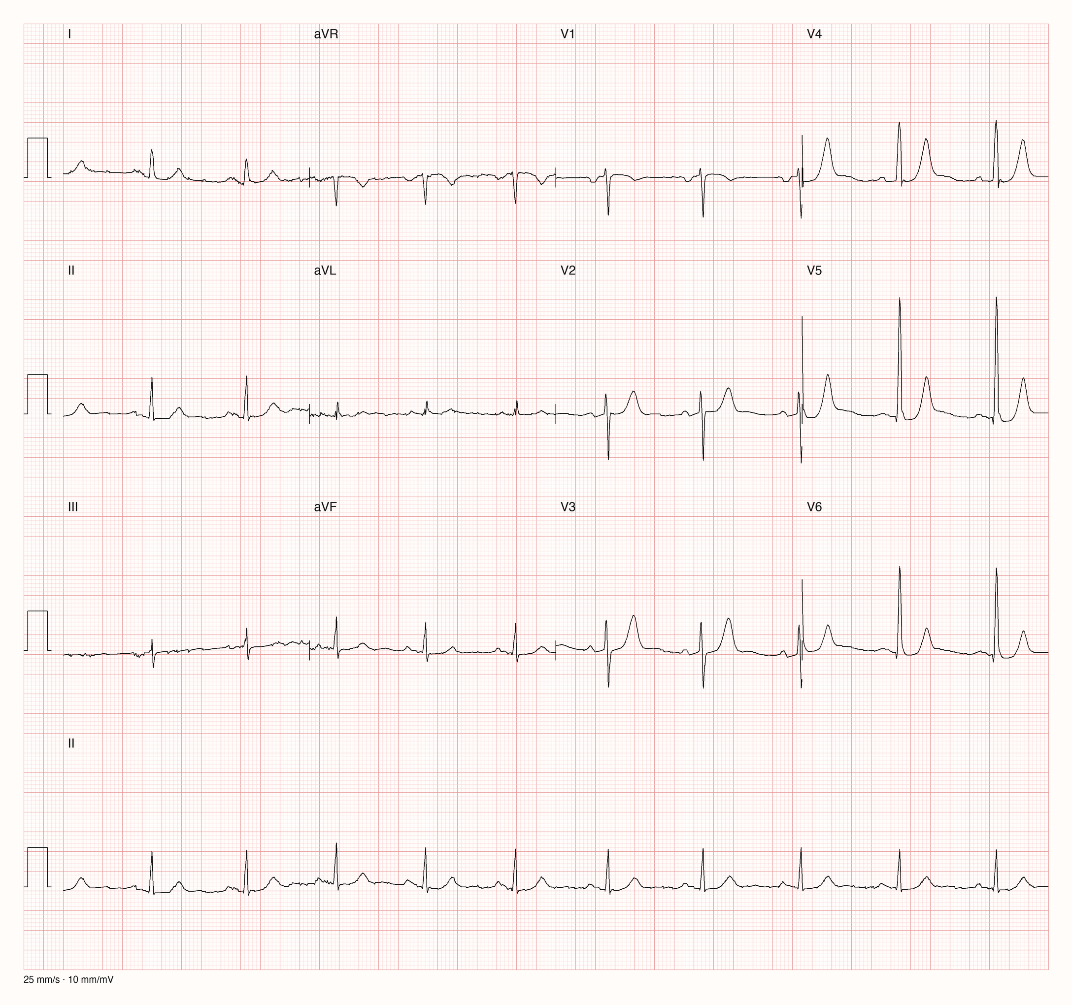 12-Kanal-EKG im Sinusrhythmus mit hohen R-Zacken in V5 und V6, hohen spitzen T-Wellen in V3 bis V5 und biphasischer P-Welle in V1; Zeilen mit erhöhtem Abstand