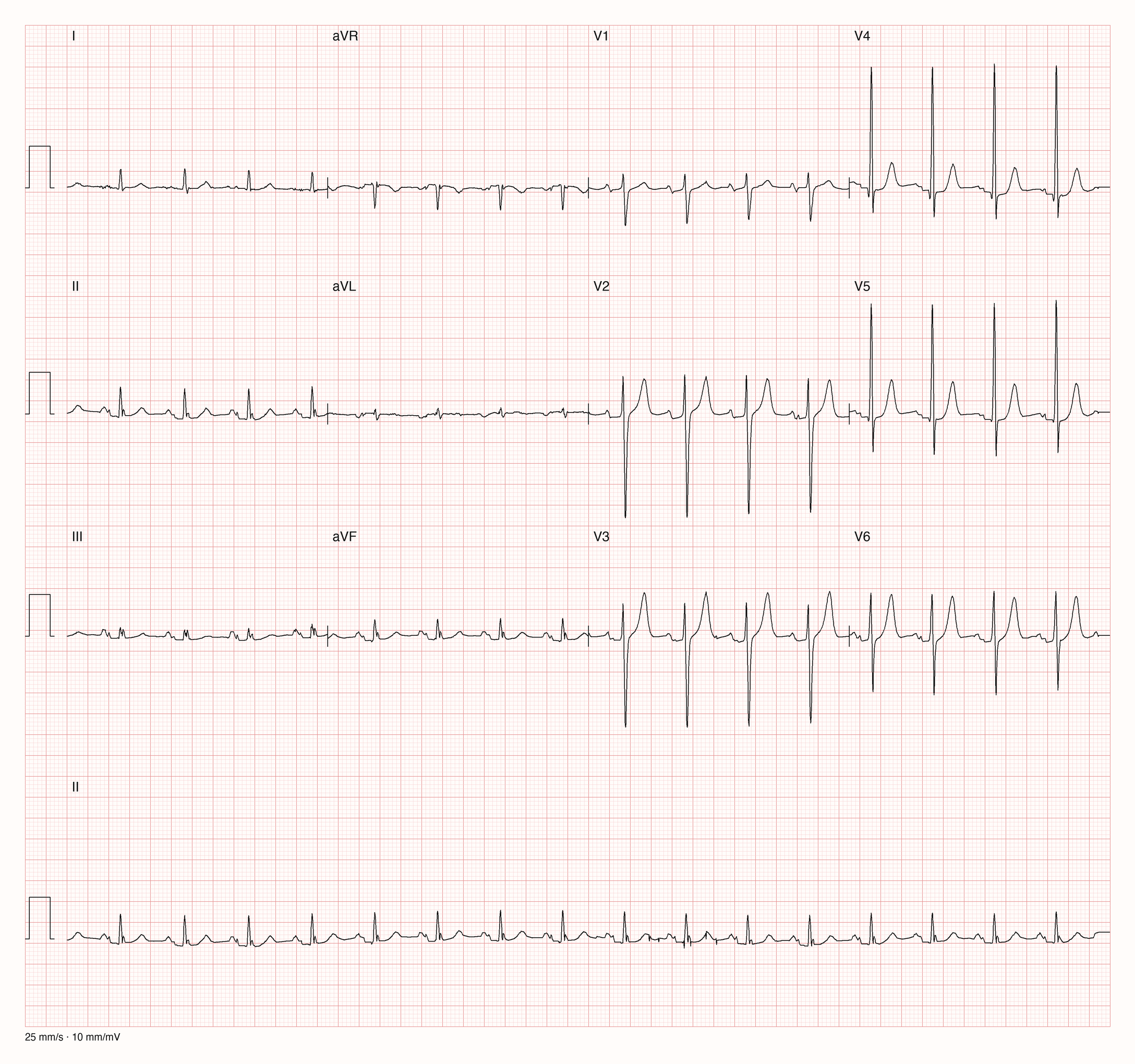 12-Kanal-EKG mit regelmäßiger Tachykardie um 100 pro Minute, kleinen Ausschlägen in den Extremitätenableitungen, tiefen S-Zacken in V2 und V3 und hohen R-Zacken in V4 und V5; Zeilen mit erhöhtem Abstand