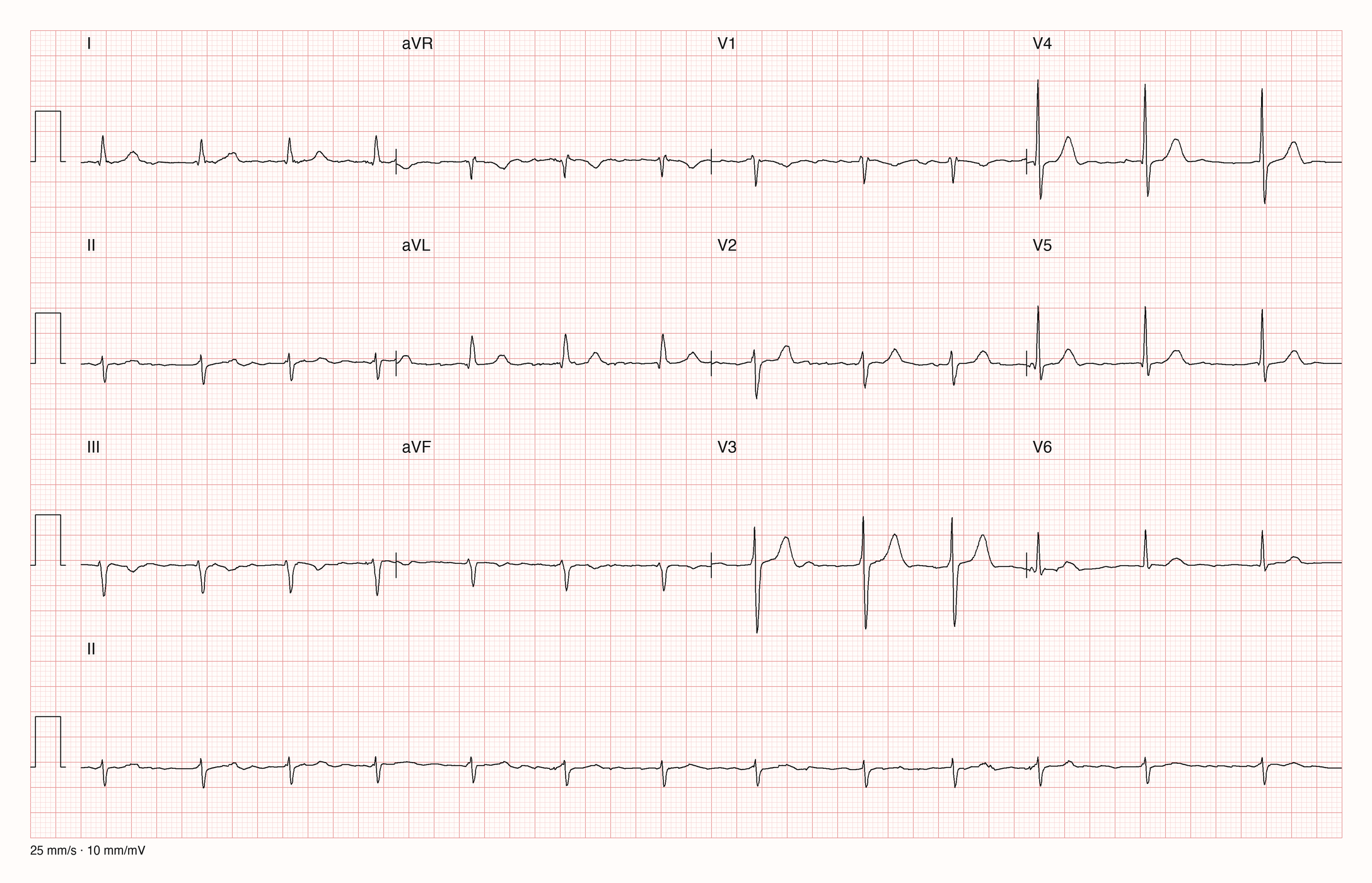 12-Kanal-EKG mit unregelmäßigen RR-Abständen ohne erkennbare P-Wellen, schmalen QRS-Komplexen und überwiegend negativem QRS in II, III und aVF