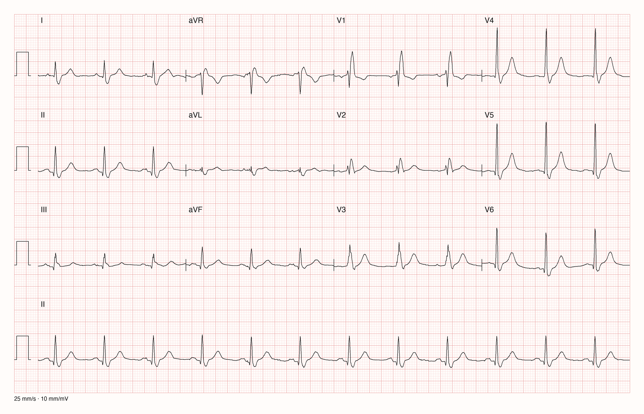 12-Kanal-EKG im Sinusrhythmus mit rSR-Komplex in V1, negativer T-Welle in V1, S-Zacken in I, V5 und V6 und überwiegend positivem QRS in II, III und aVF