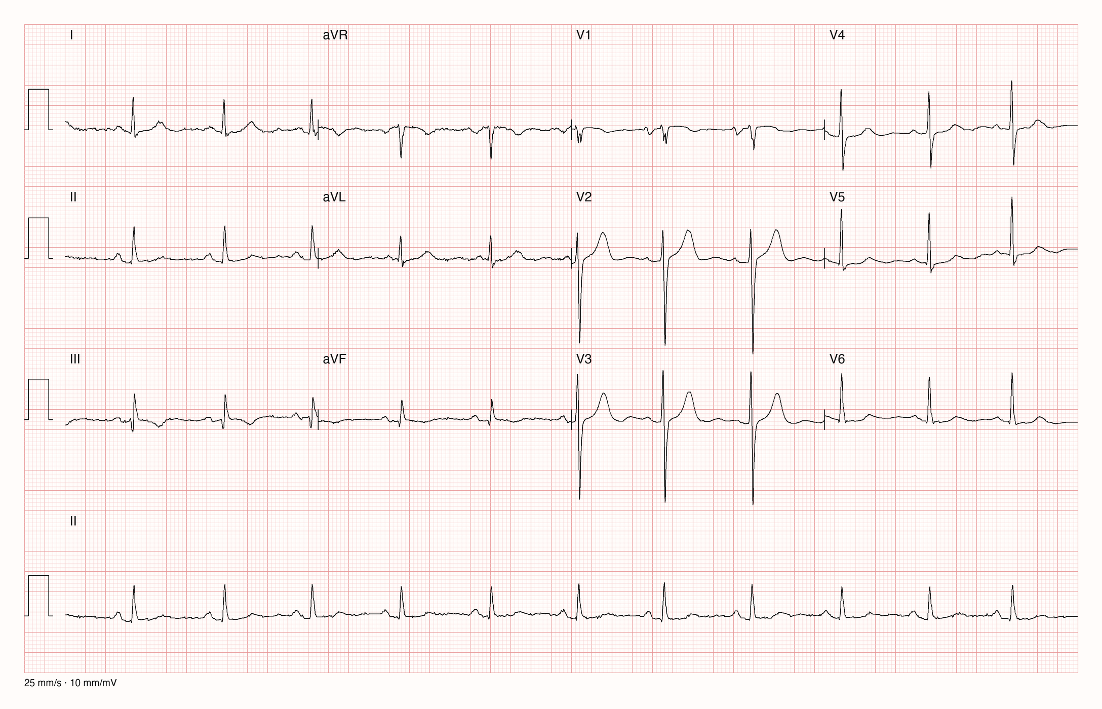 12-Kanal-EKG im Sinusrhythmus mit schmalen QRS-Komplexen, tiefen S-Zacken in V2 und V3 und biphasischer P-Welle mit breitem negativem Anteil in V1