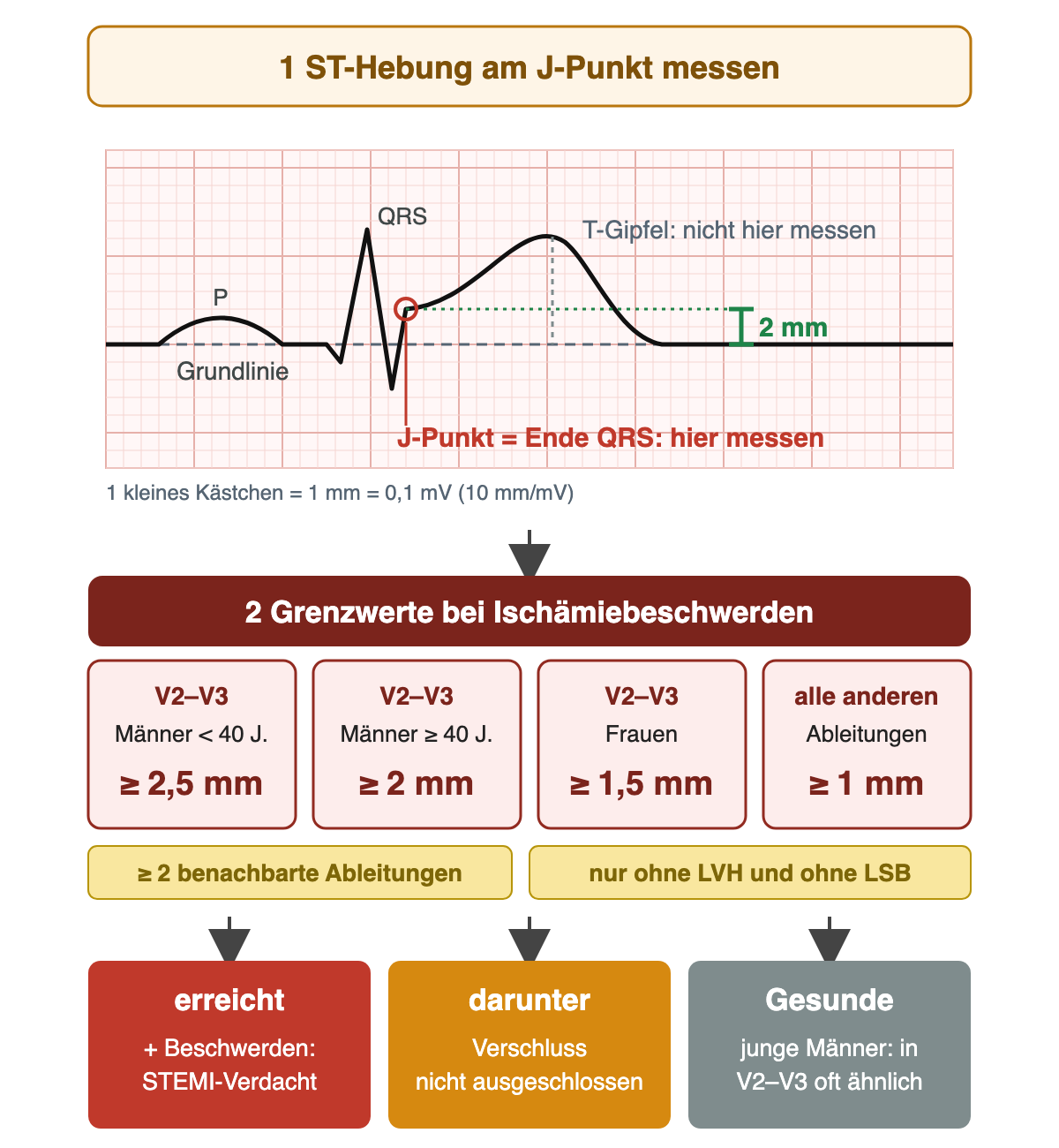 Schematischer Herzschlag auf EKG-Papier: Der J-Punkt am Ende des QRS-Komplexes ist rot markiert und liegt 2 mm über der gestrichelten Grundlinie; der Gipfel der T-Welle ist als falscher Messort gekennzeichnet. Darunter vier Grenzwertfelder für V2–V3 und die übrigen Ableitungen und drei Ergebnisfelder