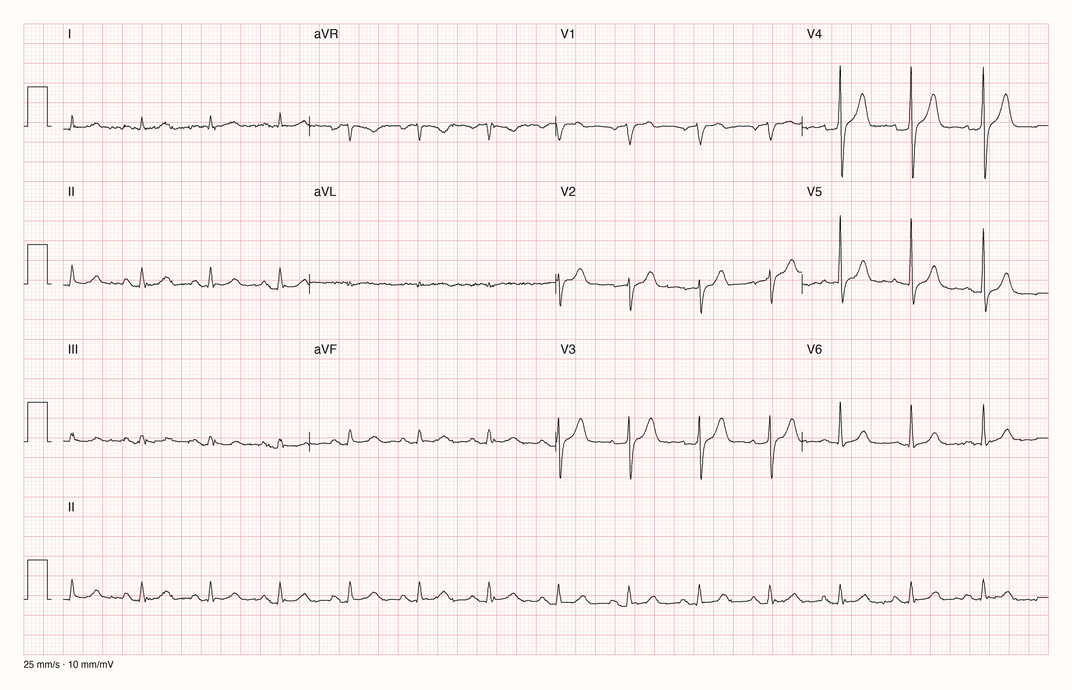 12-Kanal-EKG im Sinusrhythmus mit kleinen Ausschlägen in allen Extremitätenableitungen und normal großen Ausschlägen in V3 bis V5
