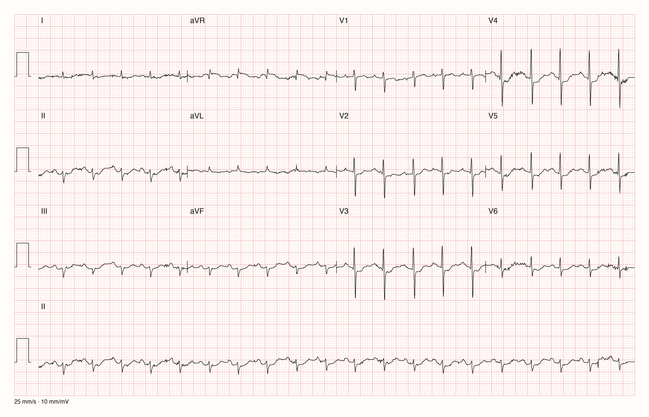 12-Kanal-EKG mit regelmäßiger Tachykardie um 120 pro Minute, sehr kleinen Ausschlägen in den Extremitätenableitungen und überwiegend negativem QRS in II, III und aVF