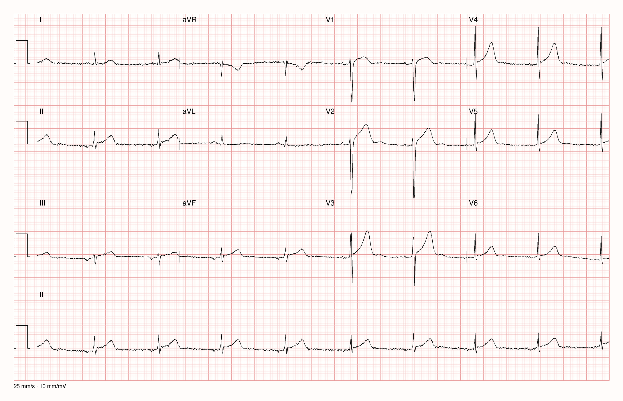 12-Kanal-EKG mit langsamem Sinusrhythmus, konkav angehobenen ST-Strecken in V2 bis V6 sowie in II, III und aVF und hohen T-Wellen
