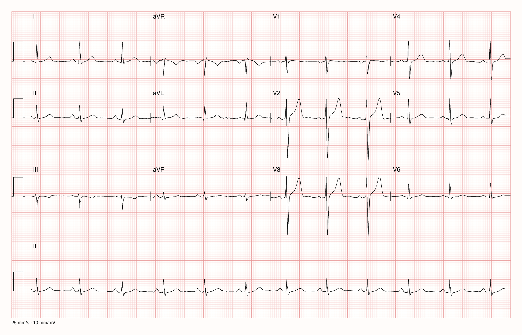 12-Kanal-EKG im Sinusrhythmus mit tiefen S-Zacken und konkav angehobener ST-Strecke mit hohen T-Wellen in V2 und V3, unauffälligen Extremitätenableitungen