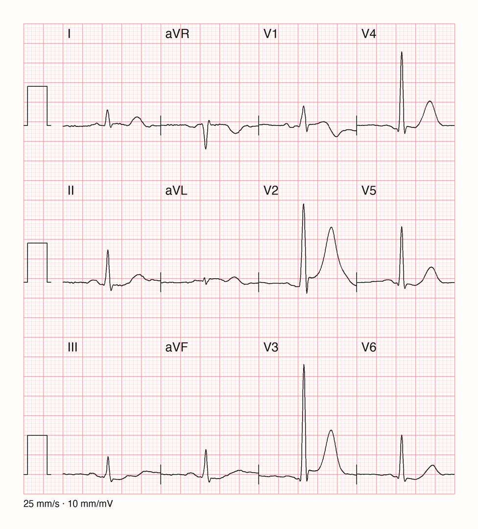 Medianschlag aller zwölf Ableitungen mit hohen, breiten T-Wellen und angehobener ST-Strecke in V2 bis V4, negativer T-Welle in V1 und leicht gesenkter ST-Strecke in III und aVF