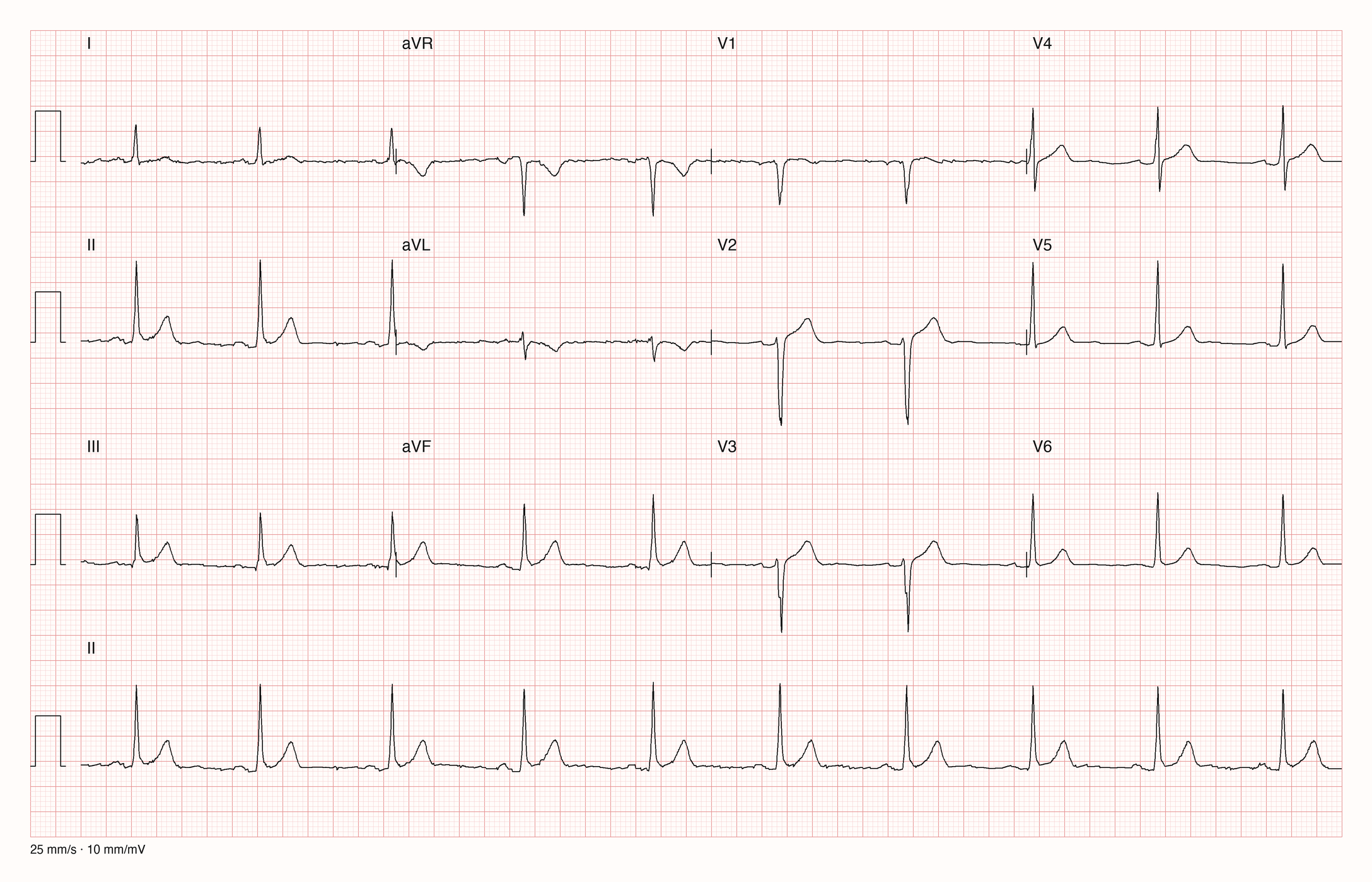 12-Kanal-EKG im Sinusrhythmus mit leicht angehobenen ST-Strecken in II, III und aVF sowie in V2 bis V4, flacher bis leicht negativer T-Welle in aVL