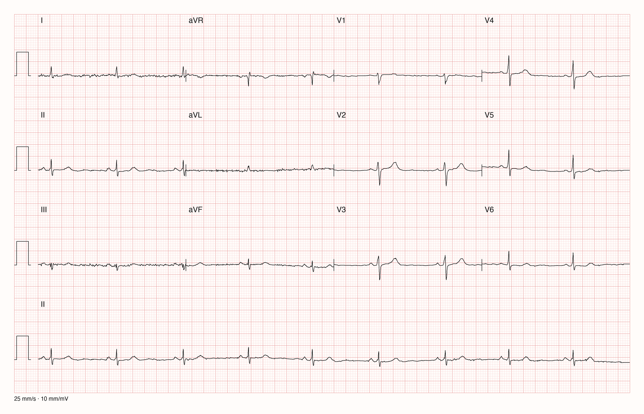 12-Kanal-EKG mit langsamem regelmäßigem Rhythmus und sehr kleinen Ausschlägen in allen zwölf Ableitungen