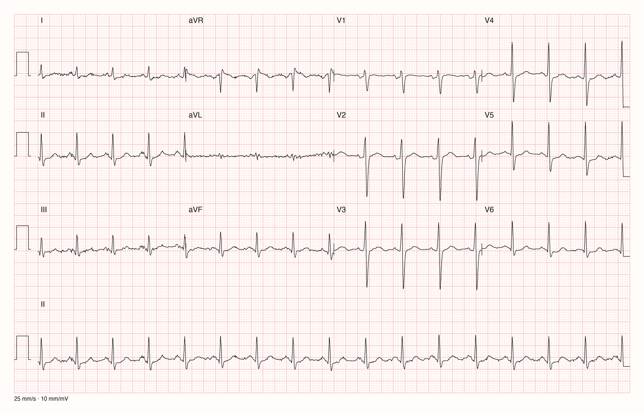Zwölfkanal-EKG mit 25 mm/s und 10 mm/mV: regelmäßiger Rhythmus mit etwa 98 Schlägen pro Minute, schmale QRS-Komplexe, in V1 zweigipflige P-Welle mit negativem Endteil; die Extremitätenableitungen I, III, aVR und aVL sind von feinem Rauschen überlagert