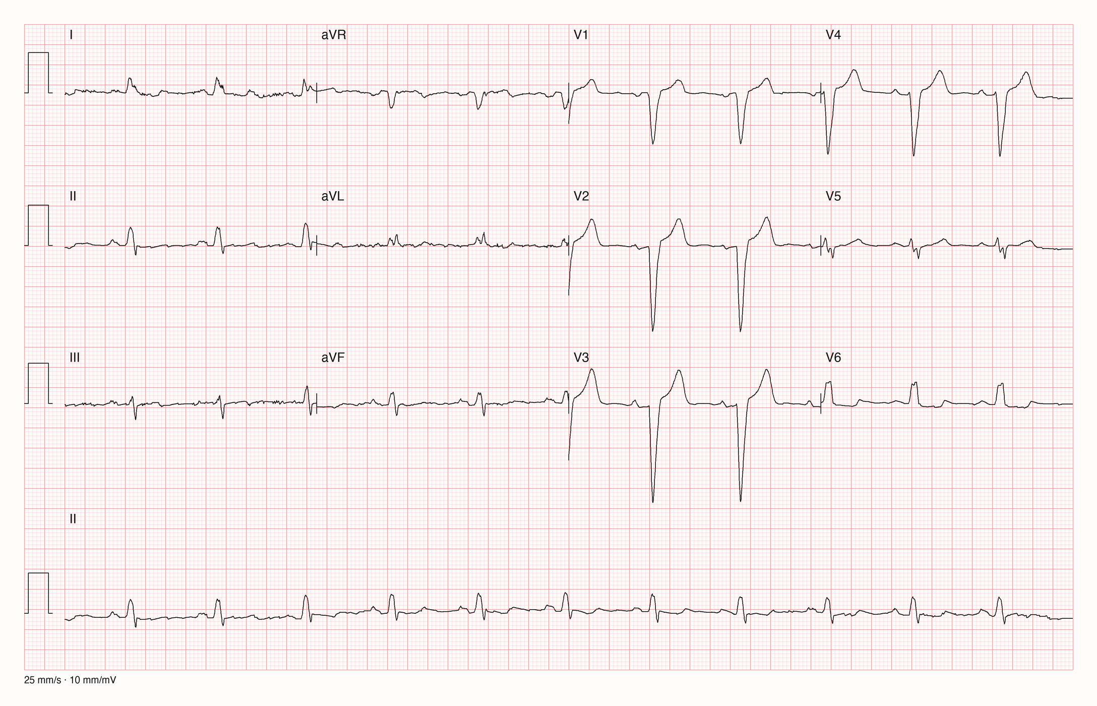 Zwölfkanal-EKG mit 25 mm/s und 10 mm/mV: Sinusrhythmus mit etwa 70 Schlägen pro Minute, verbreiterte QRS-Komplexe mit tiefem QS-Komplex und gegensinniger ST-Hebung in V1 bis V3, breite gekerbte R-Zacken in I und V6 ohne Q-Zacke; niedrige Amplituden in den Extremitätenableitungen