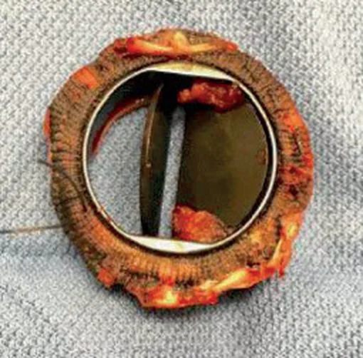 Explantierte mechanische Herzklappe auf einem Tuch: runder Nahtring, darin ein Metallring mit zwei dunklen Flügeln; rötliches Thrombusmaterial am Ring hält einen Flügel halb geschlossen