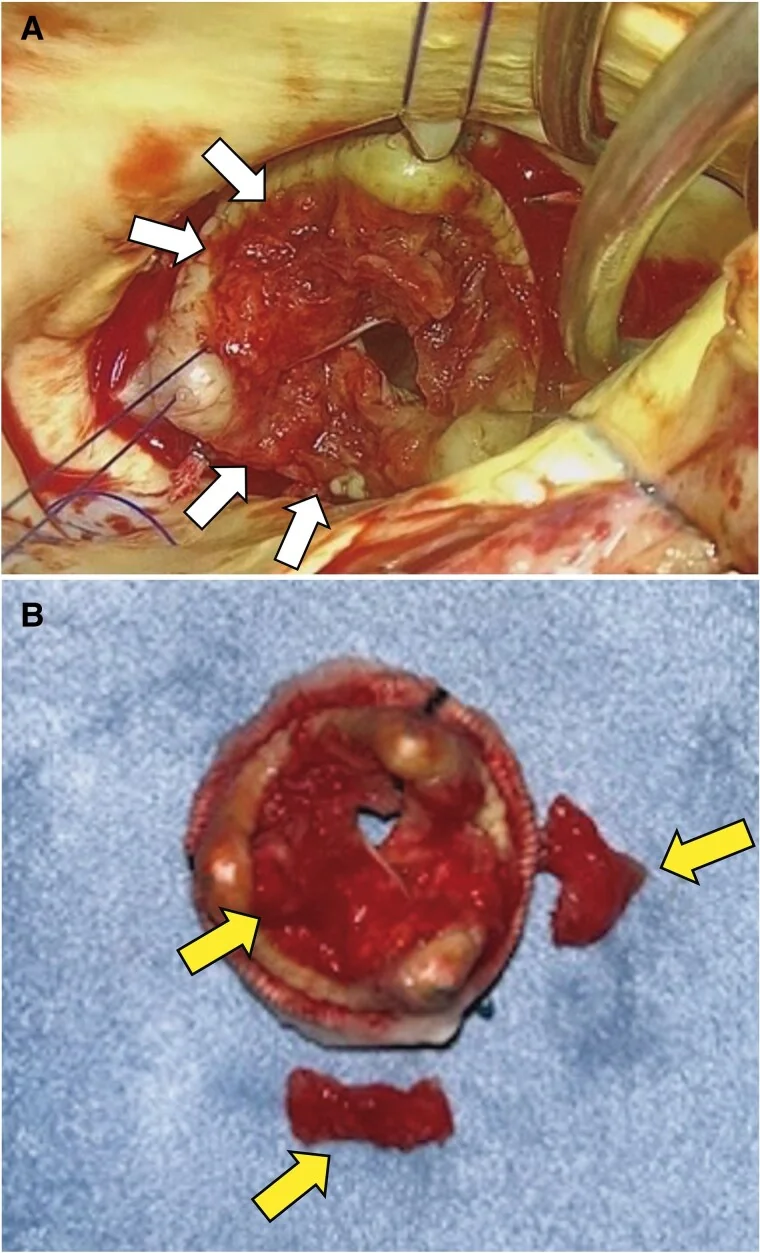 Oben Blick von der Aorta in eine biologische Klappenprothese, deren Taschen von dunkelrotem Thrombus bedeckt sind (weiße Pfeile); unten die herausgenommene Prothese mit Nahtring und Thrombusstücken (gelbe Pfeile)