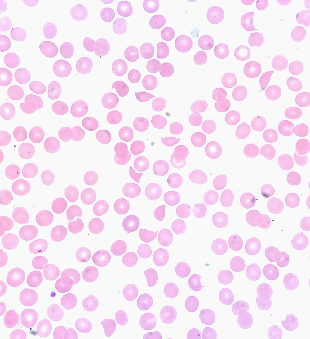 Blutausstrich mit vielen runden, rosa Erythrozyten; dazwischen einzelne kleinere, zerrissene, helm- oder dreieckförmige Zellfragmente