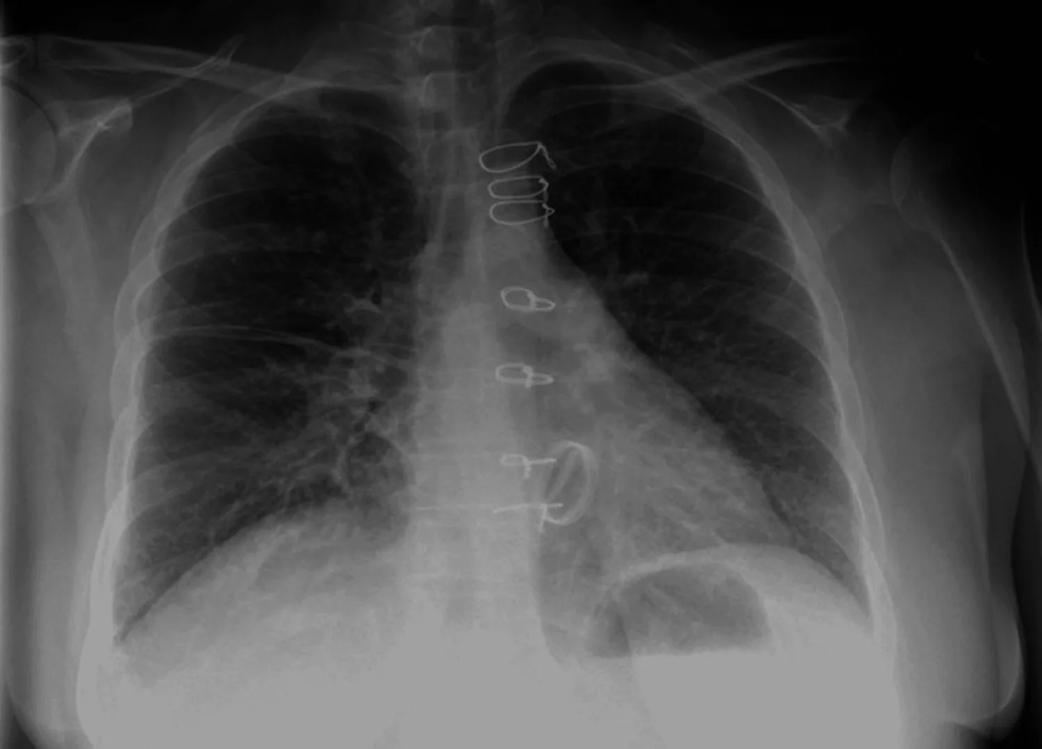 Röntgen-Thorax von vorn: in der Mitte mehrere Drahtschlingen entlang des Brustbeins, unten über dem Herzschatten ein ovaler Metallring der Klappenprothese; beide Lungen mit vermehrter, streifiger Zeichnung