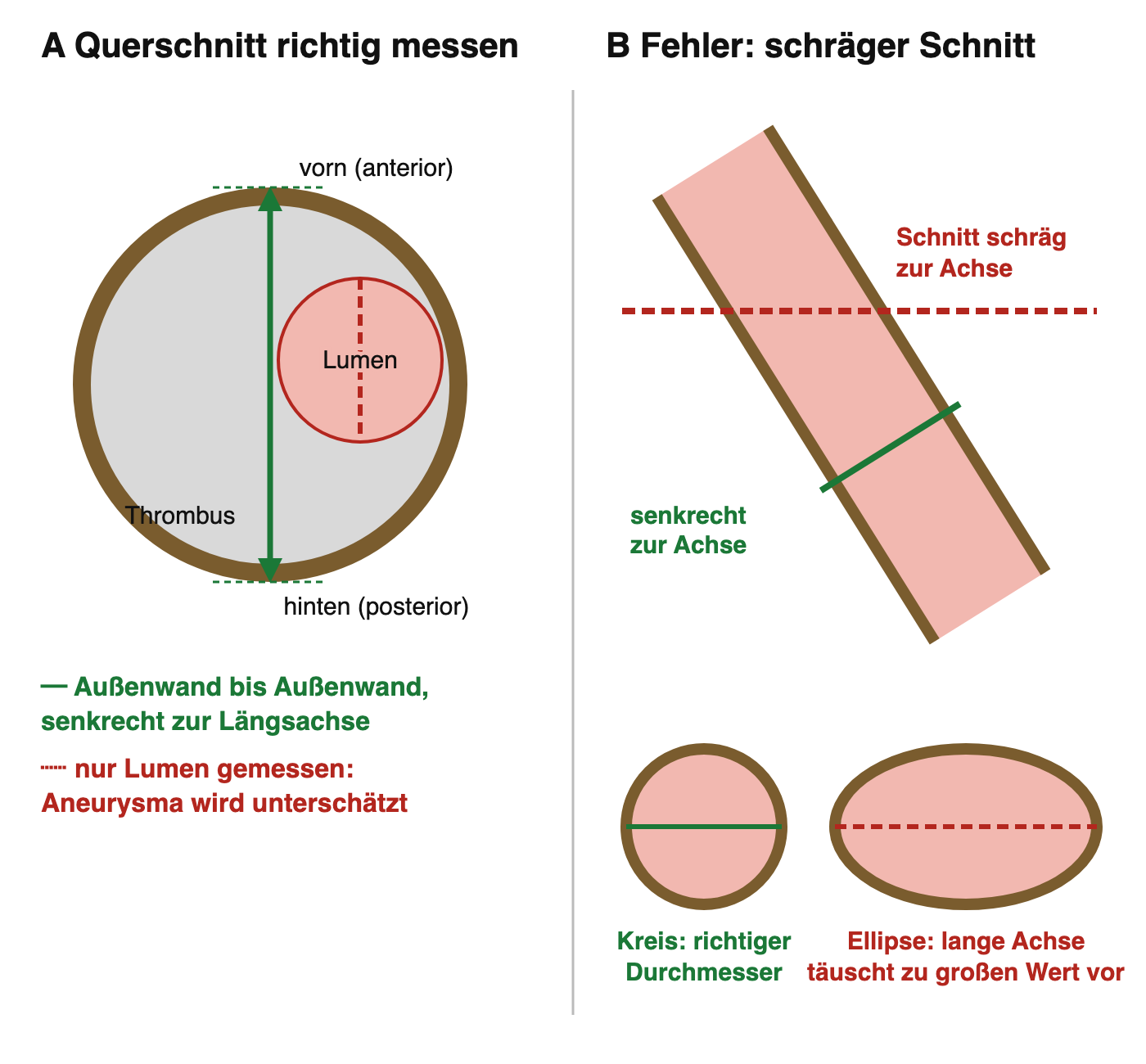 Links Querschnitt eines Aneurysmas mit Wandthrombus: grüner Messpfeil von Außenwand zu Außenwand von vorn nach hinten, rote gestrichelte Linie nur durch das Lumen; rechts schräg verlaufende Aorta mit einem schrägen und einem senkrechten Schnitt und den resultierenden Formen Kreis und Ellipse
