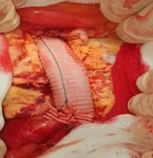 Operationsfoto durch einen Bauchschnitt: im eröffneten Retroperitoneum eine weiße, quer gerippte Rohrprothese, die an ihrem unteren Ende mit einer Nahtreihe an die Aorta genäht ist; ringsum Hände mit Handschuhen und Bauchtücher