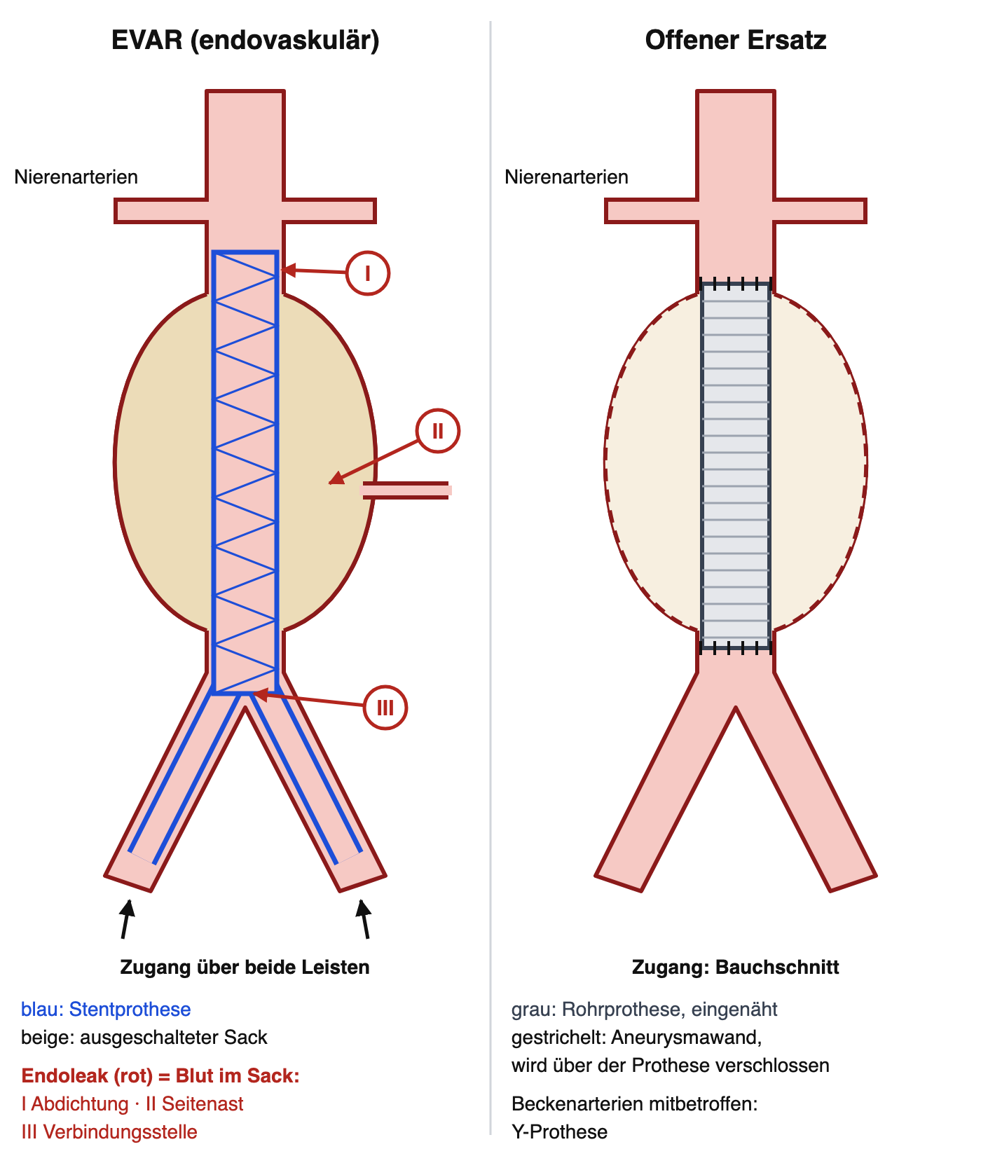Links EVAR: Stentprothese von unterhalb der Nierenarterien bis in beide Beckenarterien im ausgeschalteten Aneurysmasack, Endoleak-Stellen I an der Abdichtungszone, II an einem Seitenast und III an der Verbindungsstelle der Prothesenteile; rechts offener Ersatz mit eingenähter Rohrprothese und darüber verschlossener Aneurysmawand