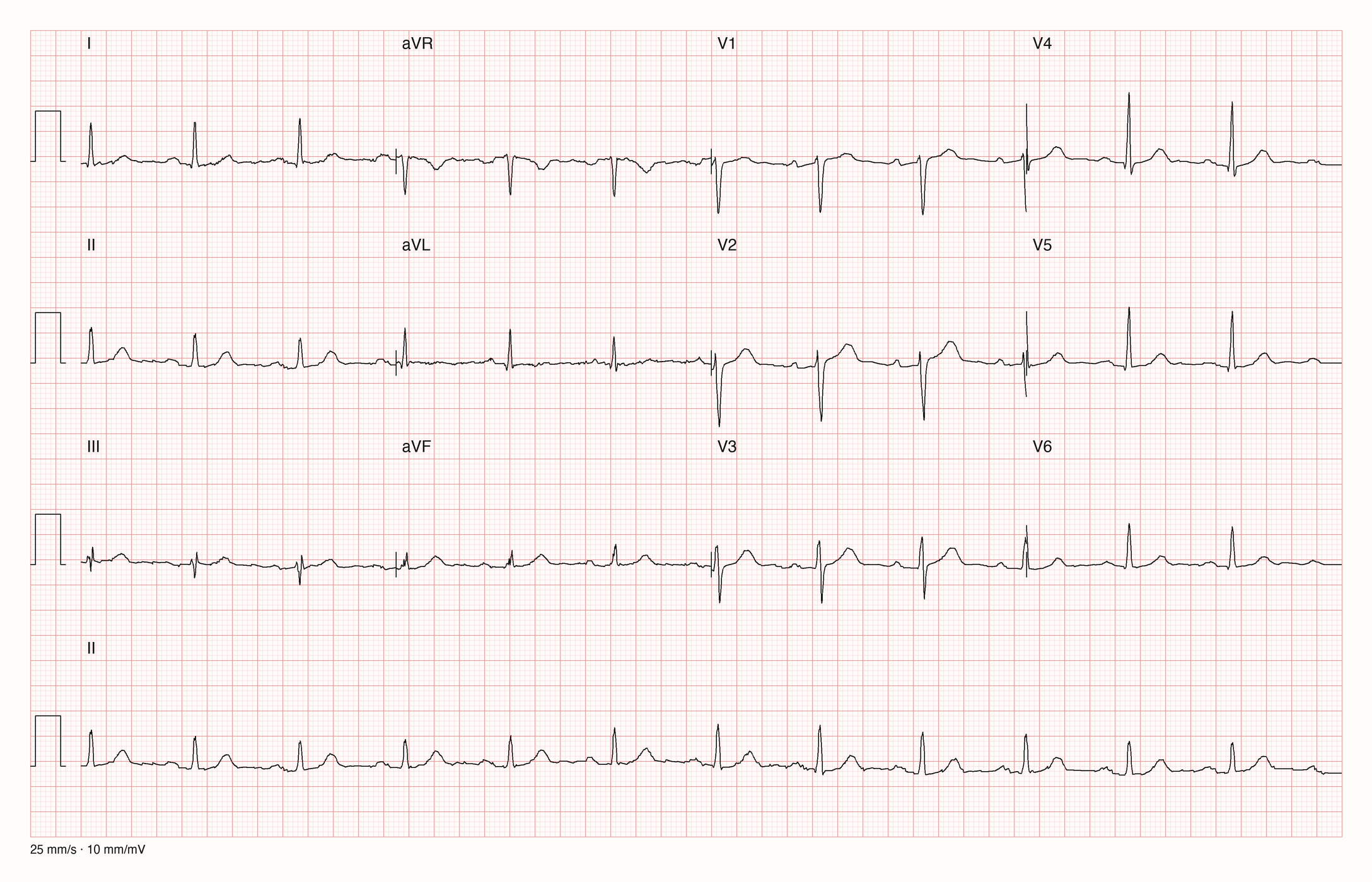 Zwölf-Kanal-EKG eines 64-jährigen Mannes mit Rhythmusstreifen in Ableitung II, 25 mm/s, 10 mm/mV