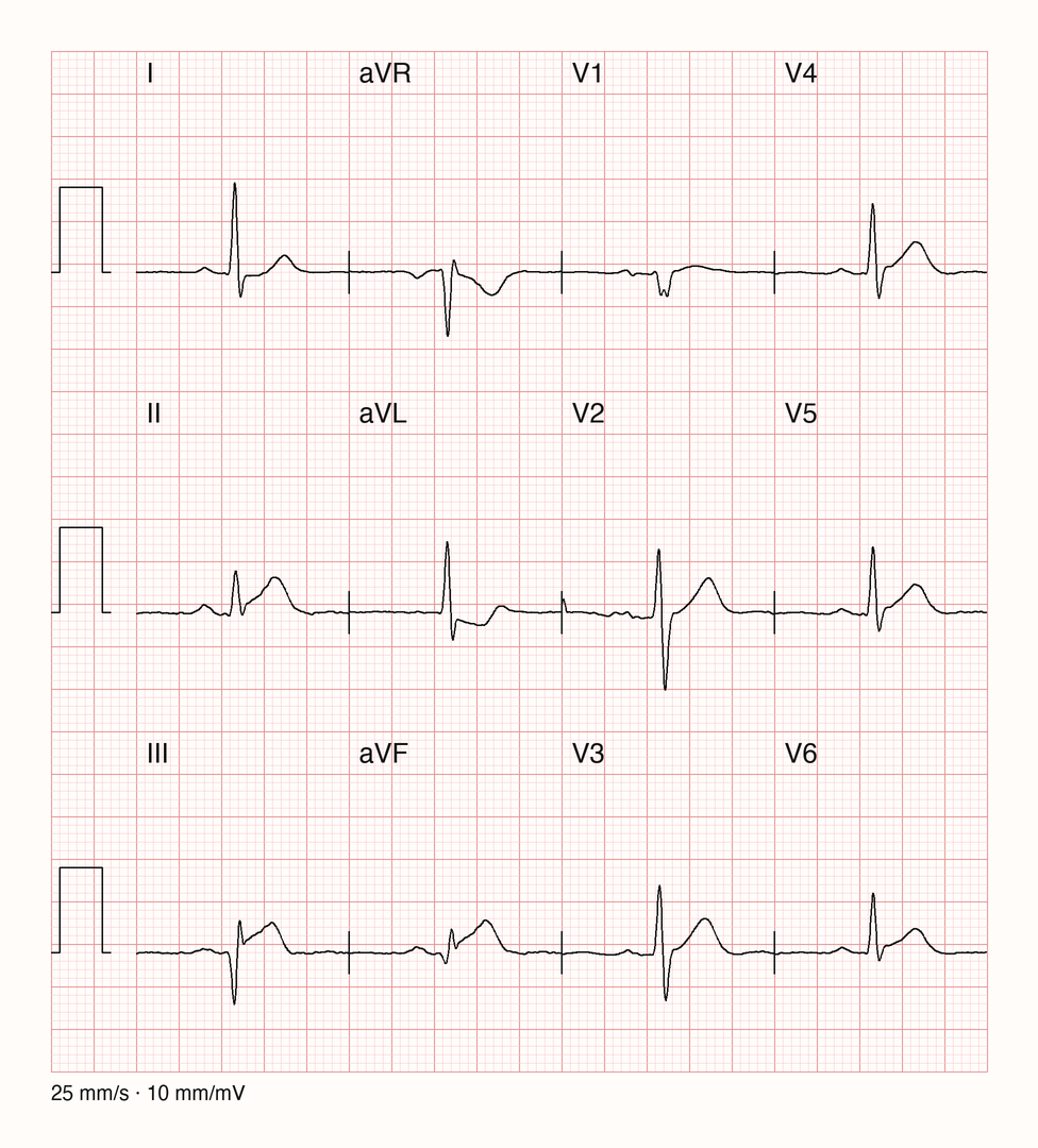 Medianschlag eines Zwölf-Kanal-EKG, 25 mm/s, 10 mm/mV
