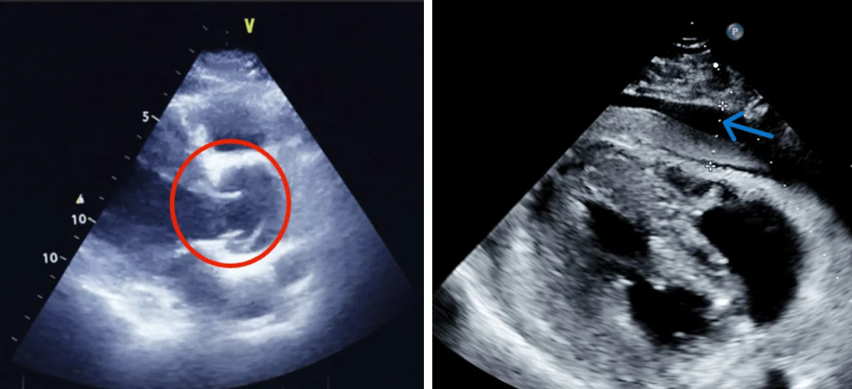 Zwei Ultraschallbilder des Herzens: links ein Längsschnitt mit rotem Kreis um eine zusätzliche Linie in der Aortenwurzel; rechts ein Schnitt von unterhalb des Brustbeins mit einem schwarzen Flüssigkeitssaum um das Herz, auf den ein blauer Pfeil zeigt