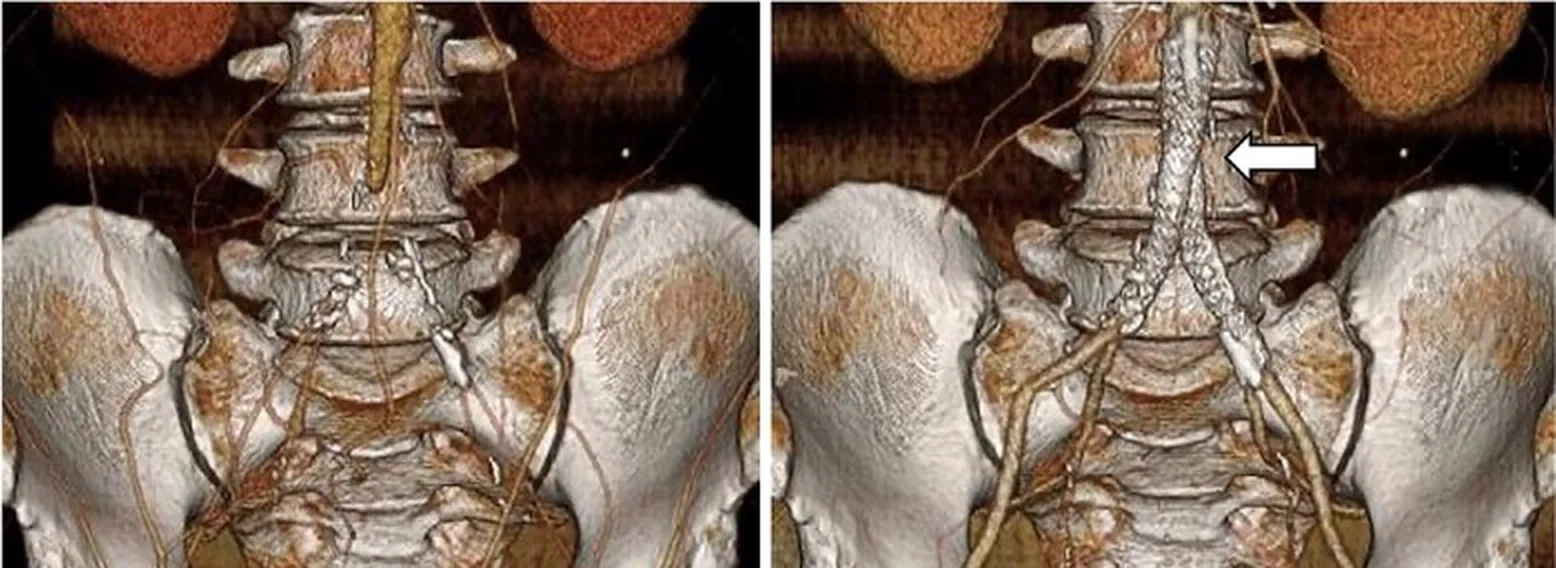 Zwei 3D-CT-Angiografien des Beckens nebeneinander: links endet die Aorta ohne Kontrastierung der Beckenarterien, rechts führen zwei nebeneinanderliegende Stents aus der Aortengabel in beide Beckenarterien (Pfeil)