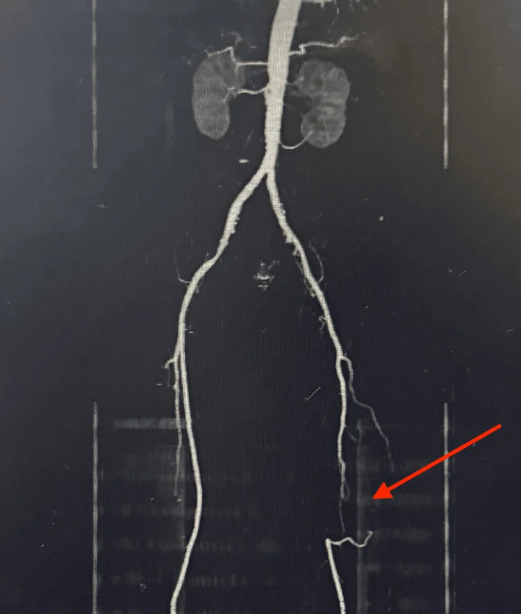 CT-Angiografie der Bauch-, Becken- und Beinarterien von vorn; die linke Oberschenkelarterie ist auf einer Strecke unterbrochen (Pfeil) und unterhalb wieder kontrastiert
