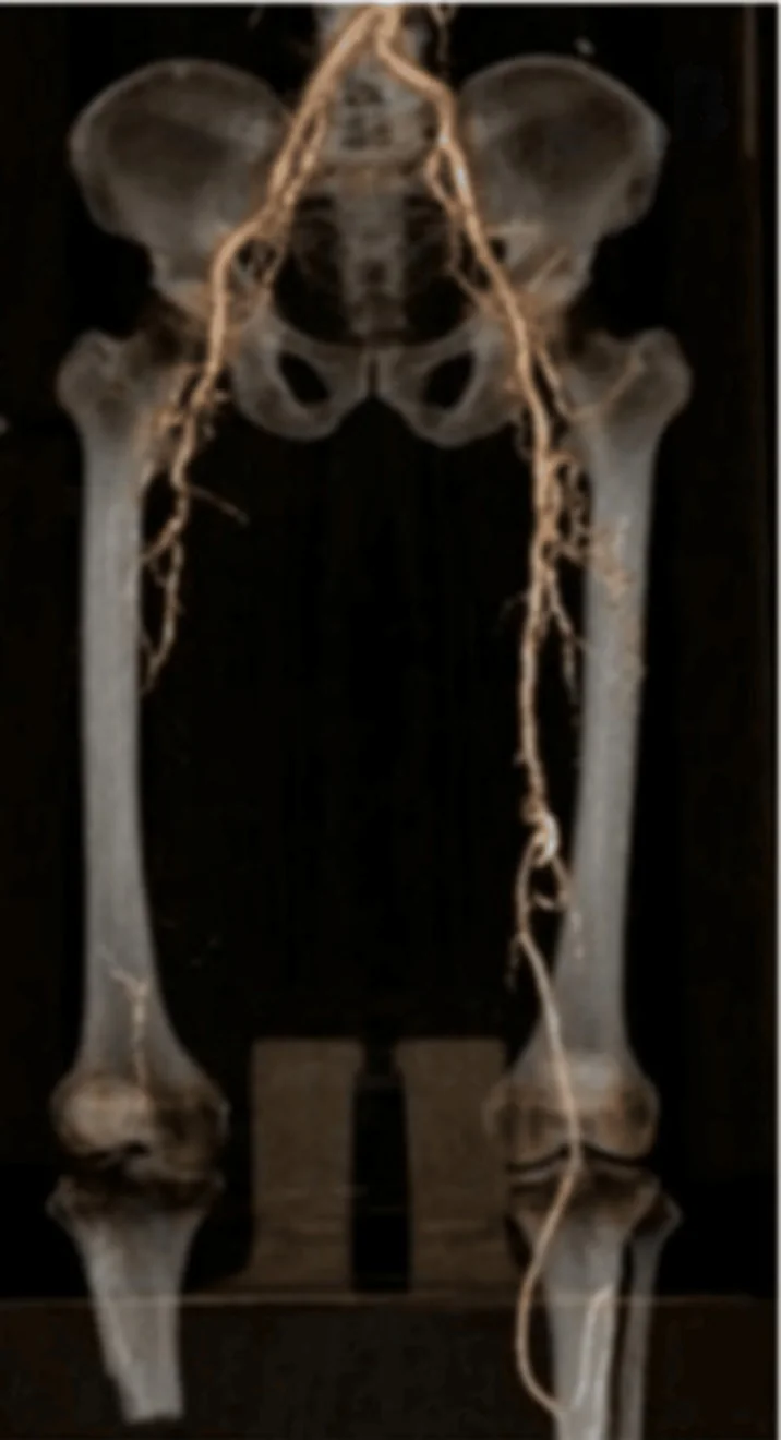 Dreidimensionale Darstellung einer CT-Angiografie: Becken, Oberschenkelknochen und Knie in Grau, darauf die Becken- und Beinarterien in Hellbraun von der Aortengabel bis unterhalb der Knie; die Arterien sind unregelmäßig, besonders an einem Oberschenkel mit vielen kleinen Ästen