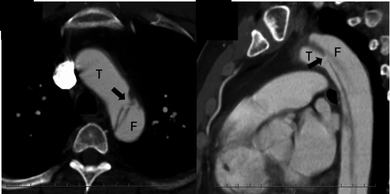 CT-Angiografie des Aortenbogens, links Querschnitt, rechts seitlicher Schnitt: Eine dünne Membran teilt die Aorta in zwei Lumina (T und F), ein schwarzer Pfeil zeigt auf den Einriss kurz hinter dem Abgang der linken A. subclavia; die aufsteigende Aorta vor dem Herzen ist einheitlich gefüllt