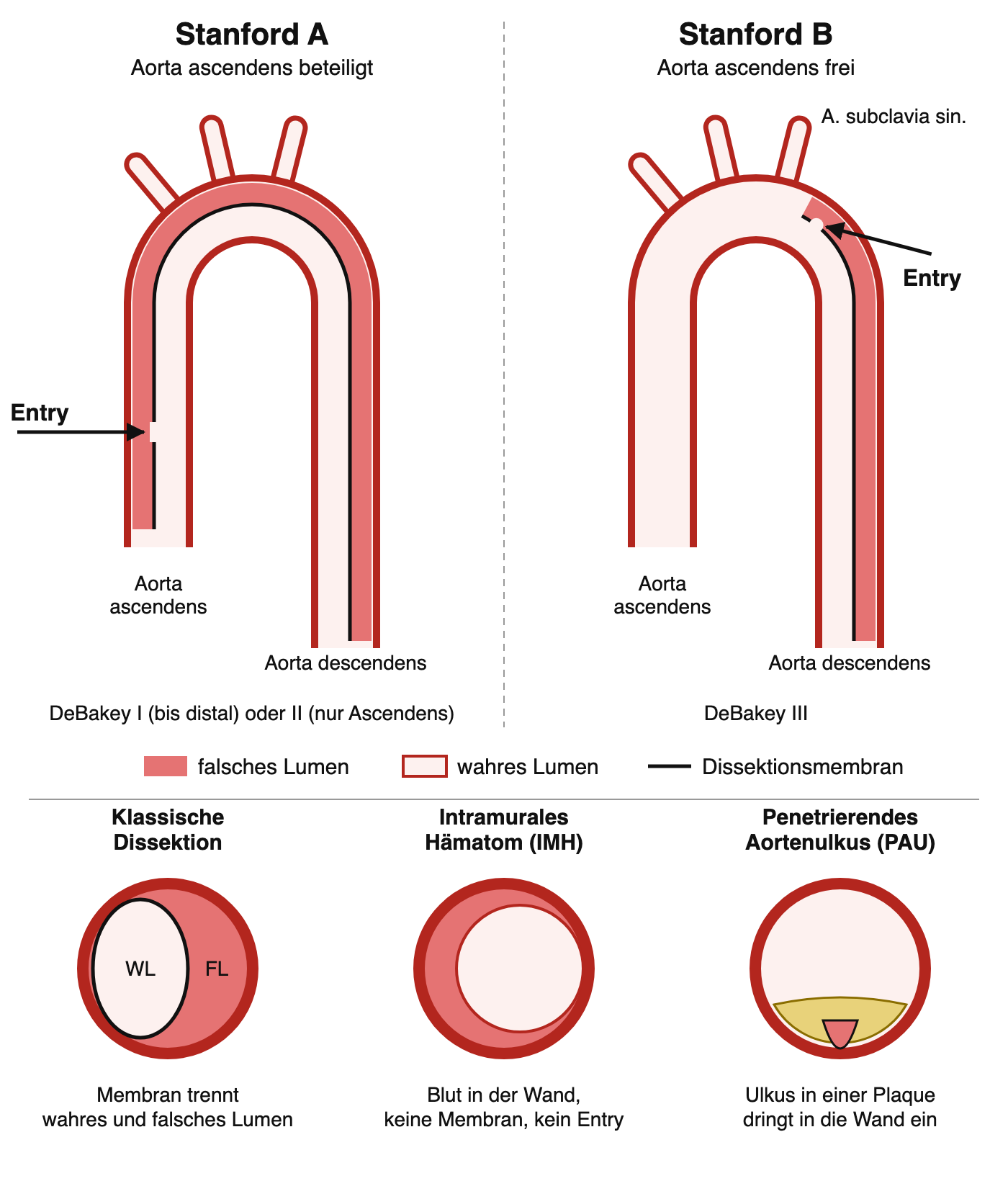Zwei stilisierte Aortenbögen: links Stanford A mit falschem Lumen ab der Aorta ascendens und Entry in der Ascendens, rechts Stanford B mit Entry distal der linken A. subclavia und falschem Lumen nur in der Aorta descendens; darunter drei Querschnitte von klassischer Dissektion, intramuralem Hämatom und penetrierendem Aortenulkus