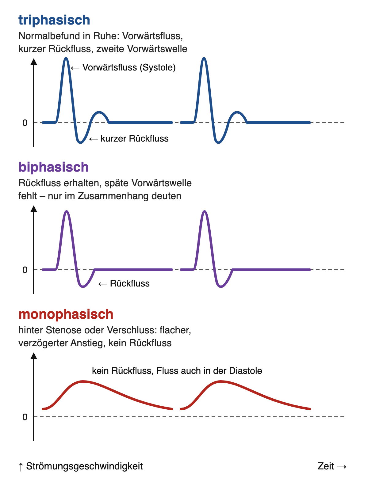 Drei Doppler-Kurvenformen untereinander: triphasisch mit Vorwärtsfluss, kurzem Rückfluss und zweiter Vorwärtswelle; biphasisch ohne späte Vorwärtswelle; monophasisch flach ohne Rückfluss