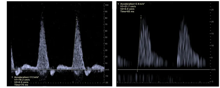 Zwei Doppler-Spektralkurven nebeneinander: links schmale, steil ansteigende Spitzen mit kurzem Ausschlag unter die Nulllinie nach jeder Spitze; rechts breitere, flach ansteigende Wellen, die nicht unter die Nulllinie reichen
