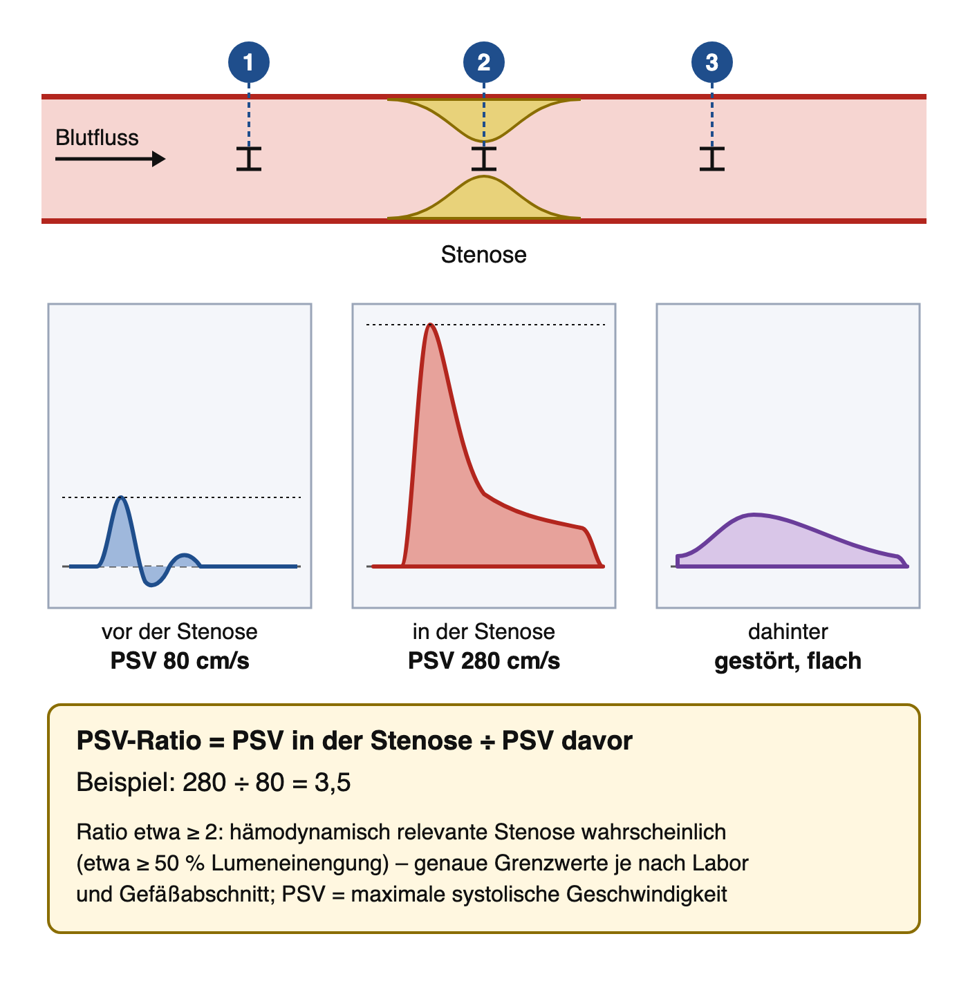 Schematische Arterie mit Stenose und drei Messfenstern; darunter die Spektren vor der Stenose mit PSV 80 cm/s, in der Stenose mit PSV 280 cm/s und dahinter gestört und flach; Formel der PSV-Ratio mit Beispiel 280 geteilt durch 80 gleich 3,5
