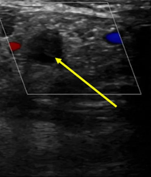 Duplexsonografie im Querschnitt: Die Armarterie ist mit grauem, echoreichem Material gefüllt (gelber Pfeil) und zeigt im Farbfenster kein Flusssignal; daneben kleine Gefäße mit rotem und blauem Farbsignal