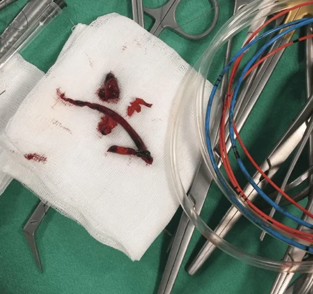 Operationsfoto: auf einer weißen Kompresse liegt ein langer, dunkelroter, wurstförmiger Embolus mit einigen kleineren Gerinnselstücken; daneben chirurgische Instrumente