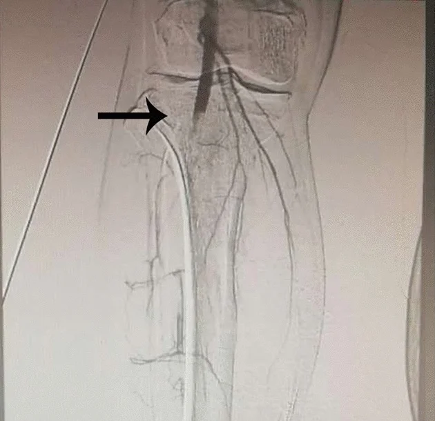Angiografie der Kniekehle und des Unterschenkels: Die kontrastierte A. poplitea endet abrupt in Höhe des Kniegelenks (schwarzer Pfeil), unterhalb füllen sich nur dünne Kollateralen