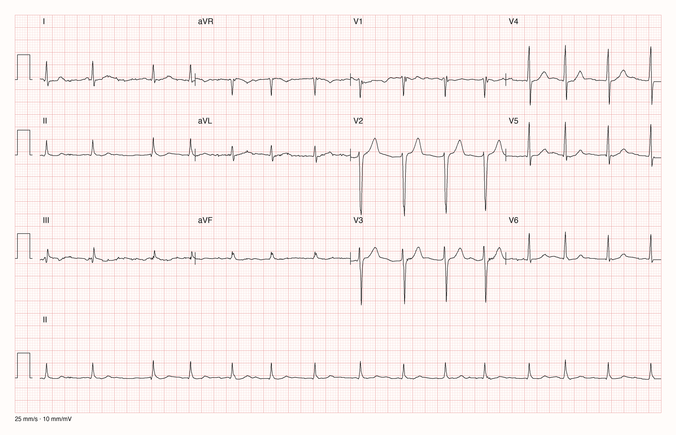 12-Kanal-EKG eines 79-jährigen Mannes, Ableitungen I bis V6 und Rhythmusstreifen in II, 25 mm/s, 10 mm/mV