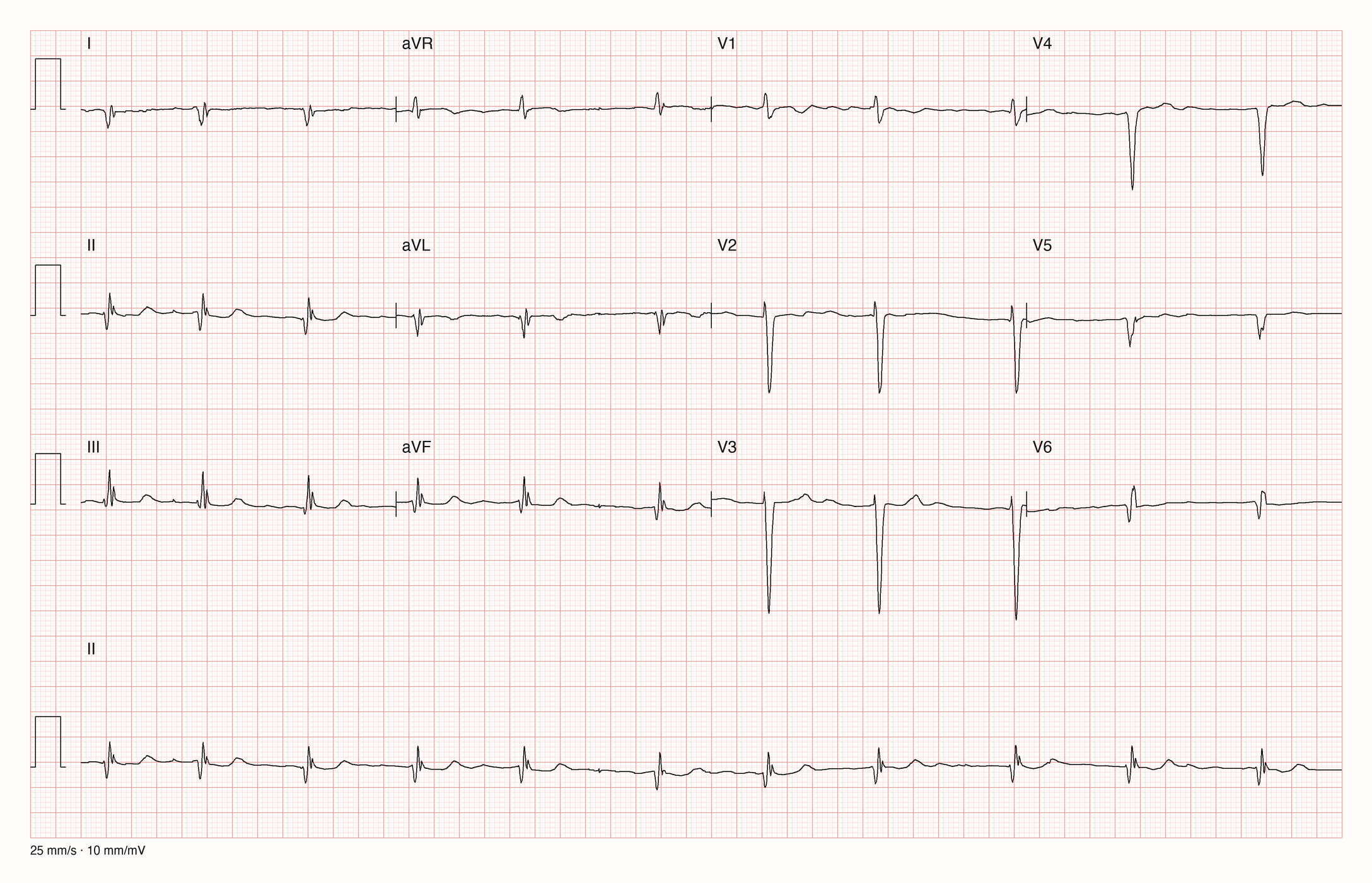 12-Kanal-EKG eines 68-jährigen Mannes, Ableitungen I bis V6 und Rhythmusstreifen in II, 25 mm/s, 10 mm/mV