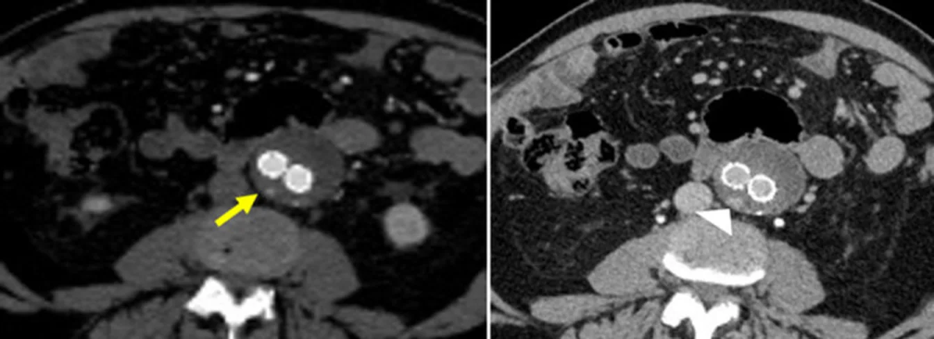 Zwei axiale CT-Schnitte des Bauches: im Aneurysmasack vor der Wirbelsäule zwei helle Ringe der Prothesenschenkel; links zeigt ein gelber Pfeil auf einen kleinen Kontrastmittelfleck im Sack neben den Ringen, rechts zeigt eine weiße Pfeilspitze auf eine größere Kontrastmittelansammlung am hinteren Rand des Sacks