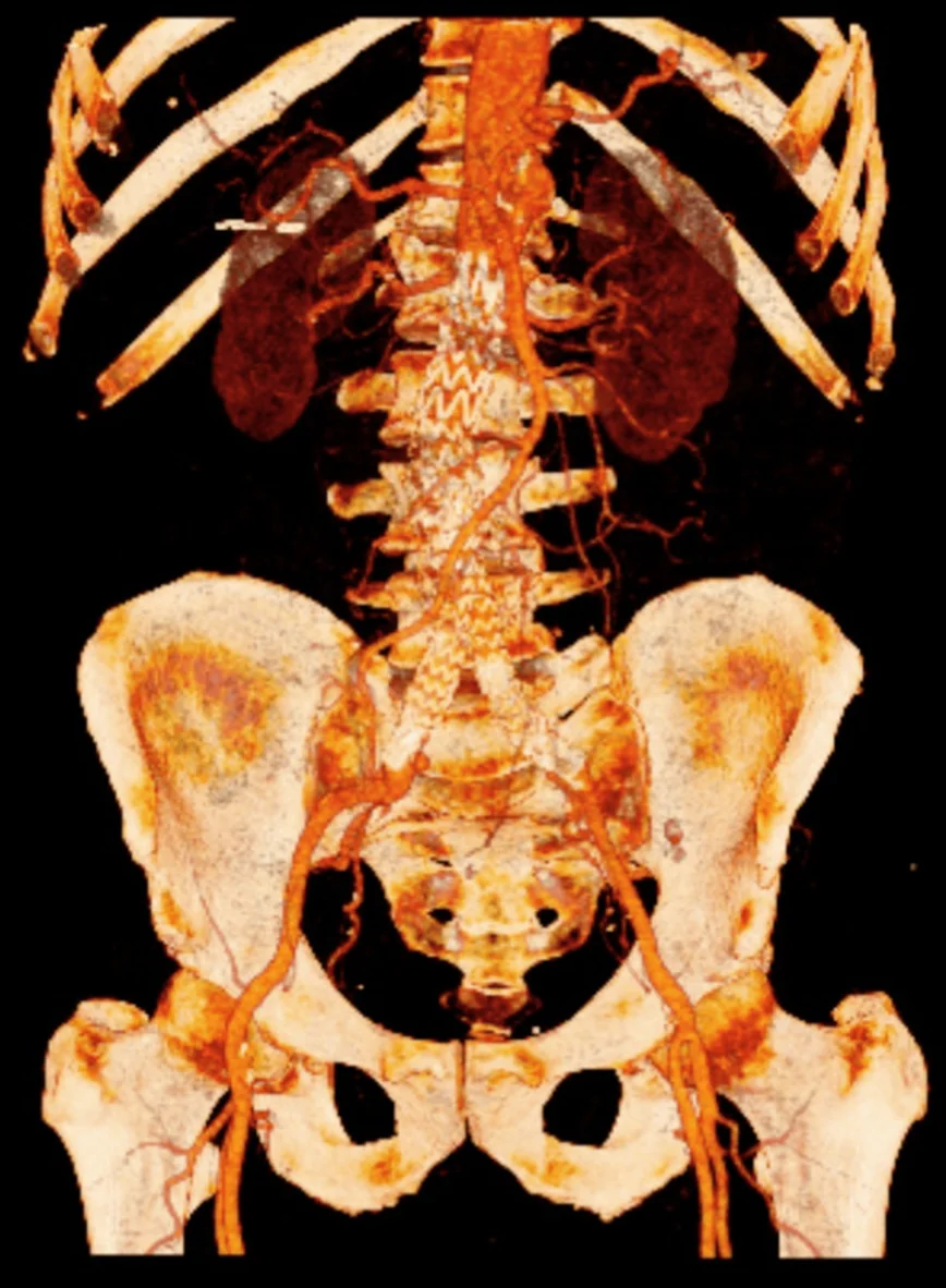 3D-Rekonstruktion einer CT-Angiografie von Bauch und Becken von vorn: In der Bauchaorta unterhalb der Nierenarterien liegt eine Y-förmige Stentprothese mit sichtbarem Drahtgerüst, deren zwei Schenkel in die Beckenarterien reichen