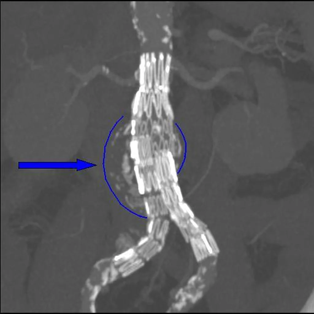 CT-Angiografie in koronarer Rekonstruktion: Y-förmige, weiß dargestellte Stentprothese in der Bauchaorta mit zwei Schenkeln in die Beckenarterien; ein blauer Kreis und ein blauer Pfeil markieren den Aneurysmasack um die Prothese