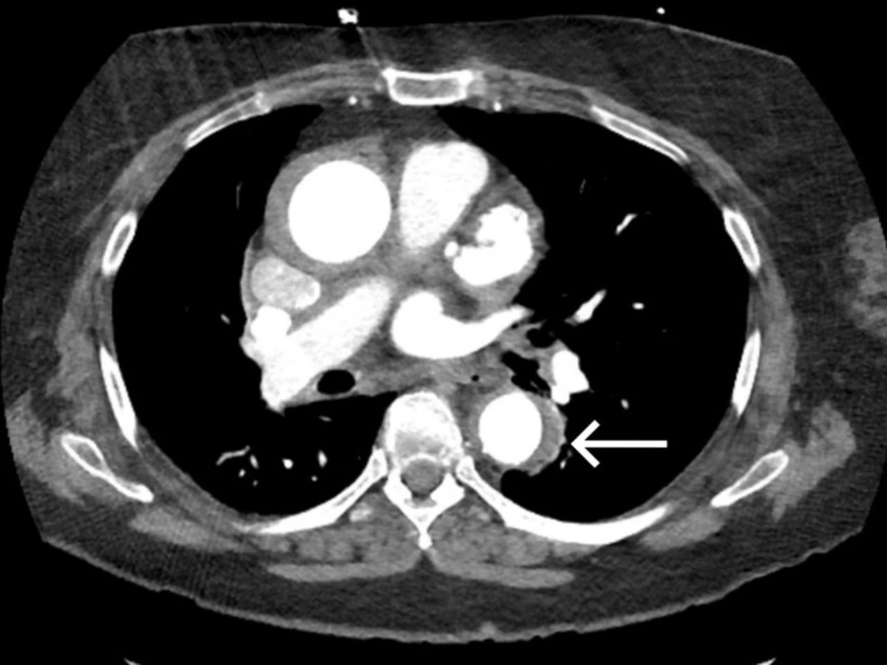 CT-Angiografie, axialer Schnitt durch den Thorax: Die Wand der Aorta descendens ist halbmondförmig verdickt (Pfeil); das Lumen ist glatt begrenzt, eine Membran oder ein zweites Lumen ist nicht zu sehen.