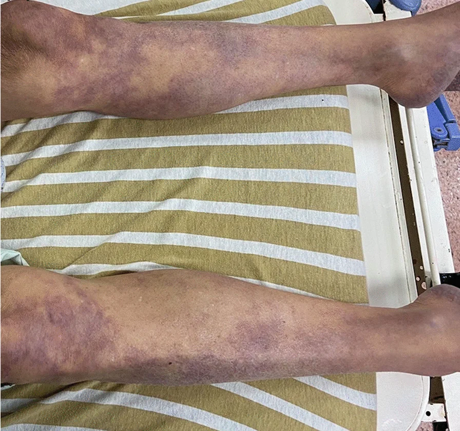 Beide Unterschenkel eines Patienten mit akuter Beinischämie, fleckig blau-livide marmoriert, am deutlichsten an Wade und Knöchel