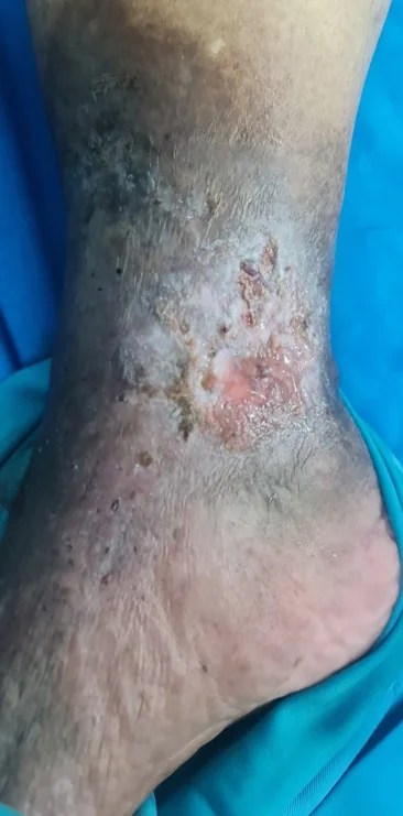 Foto des Unterschenkels oberhalb des Innenknöchels: eine flache, unregelmäßig begrenzte, nässende Wunde mit rötlichem Grund, ringsum bräunlich-dunkel verfärbte, verhärtet wirkende Haut