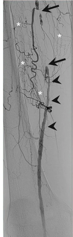 Digitale Subtraktionsangiografie eines Oberschenkels: Die A. femoralis superficialis ist zwischen zwei Pfeilen verschlossen, viele geschlängelte Umgehungsgefäße (Sterne) überbrücken die Strecke, darunter ist die Arterie wieder gefüllt (Pfeilspitzen)