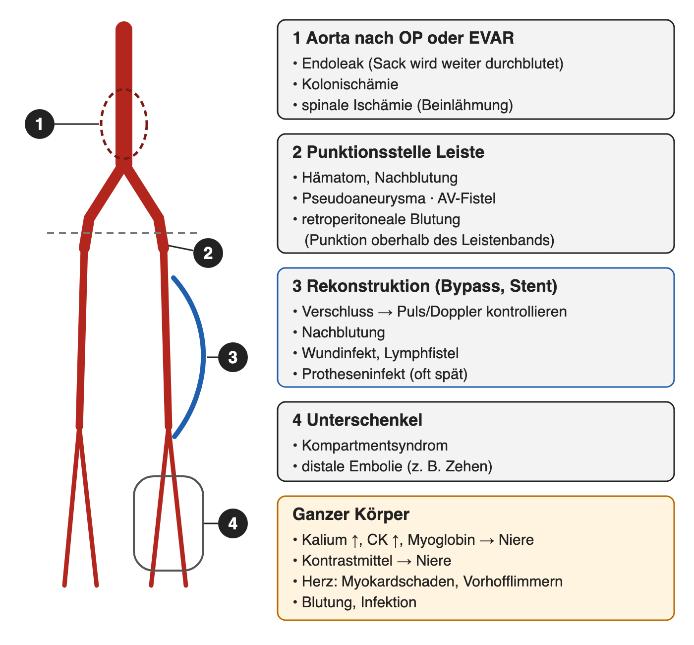 Schematischer Gefäßbaum von der Aorta bis zum Unterschenkel mit vier nummerierten Orten und daneben fünf Kästen: 1 Aorta nach OP oder EVAR, 2 Punktionsstelle Leiste, 3 Rekonstruktion, 4 Unterschenkel, außerdem Komplikationen am ganzen Körper