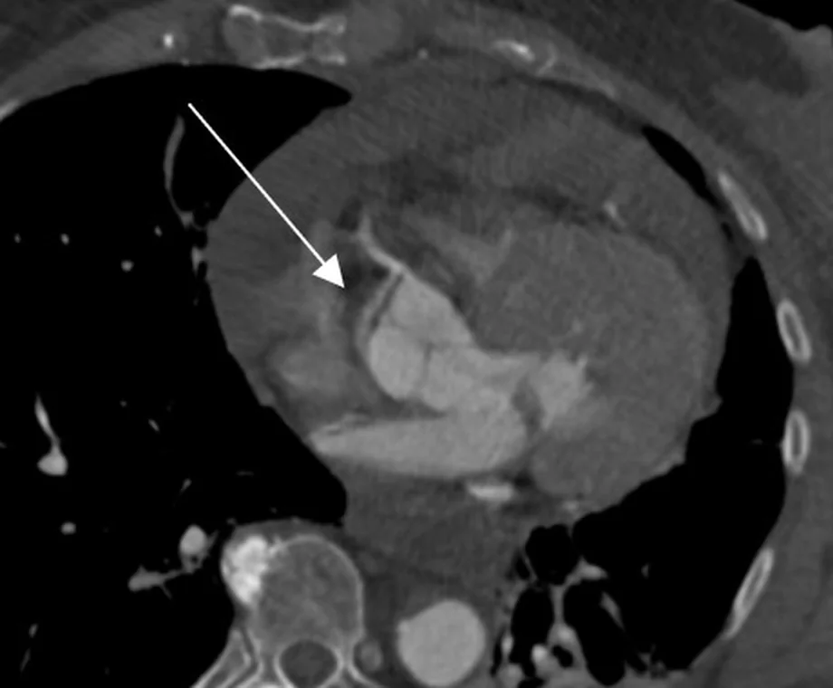 Axiale CT-Angiografie des Thorax in Höhe der Aortenwurzel: Ein weißer Pfeil zeigt auf den Abgang der rechten Koronararterie, in den eine feine dunkle Membran aus der Aortenwurzel hineinzieht; hinten links neben der Wirbelsäule die runde Aorta descendens
