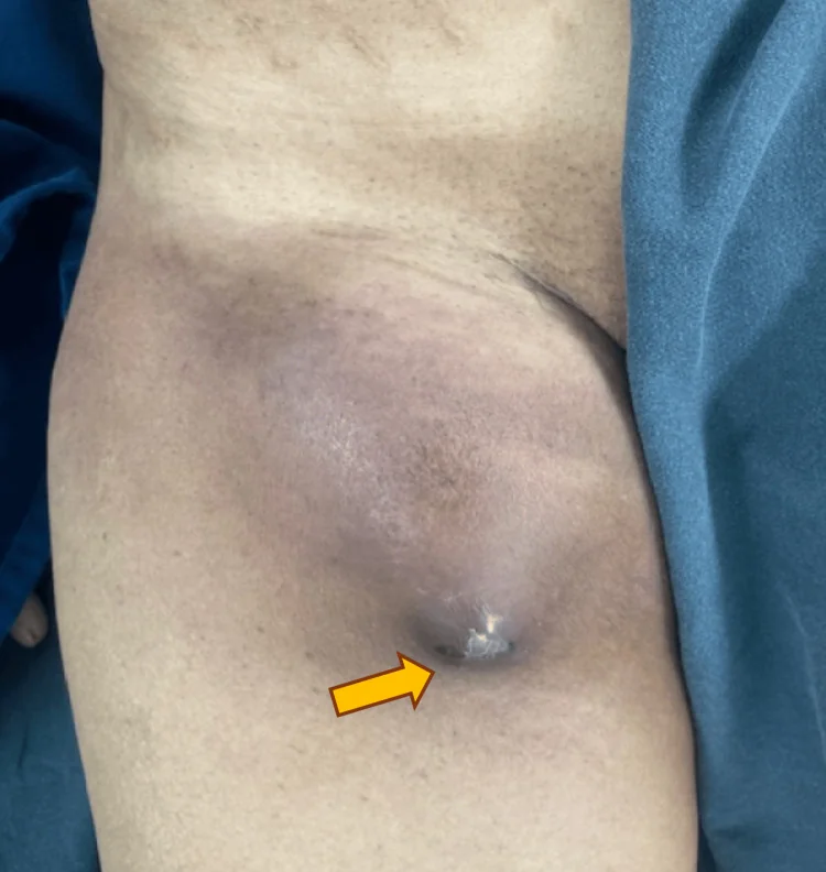 Foto der rechten Leiste und des Oberschenkels: eine große, vorgewölbte Schwellung unterhalb des Leistenbands mit bläulich-violetter Verfärbung; ein gelber Pfeil zeigt auf eine dunkle Stelle an der Kuppe