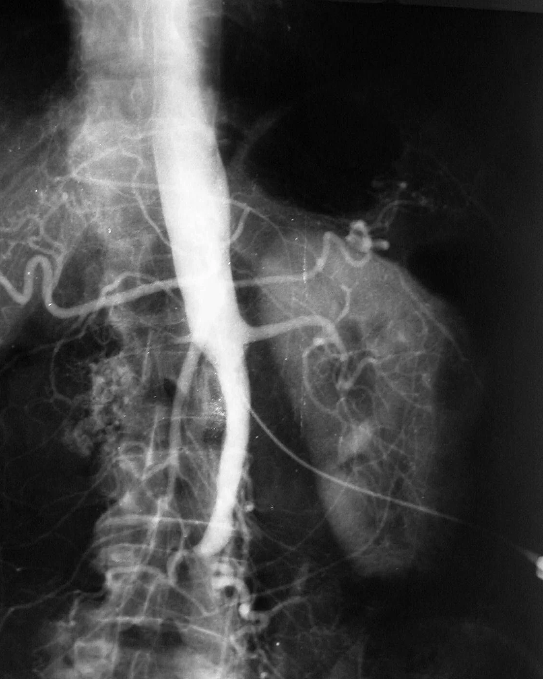 Angiografie der Bauchaorta von vorn: Die kontrastierte Aorta reicht unterhalb der Nierenarterien nur bis etwa zur Höhe des unteren Lendenwirbels und endet dort stumpf; die Beckenarterien füllen sich nicht, seitlich zahlreiche feine Kollateralen